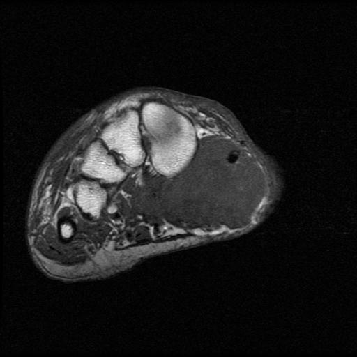 Synovial Sarcoma Foot MRI0002